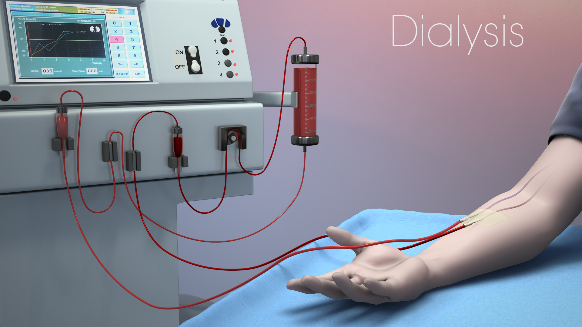 Key-Advancement-in-Hemodialysis