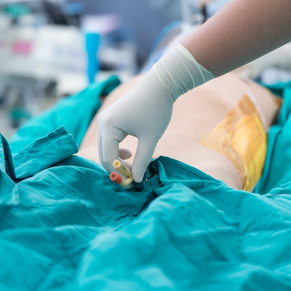 disposable urethral catheter set