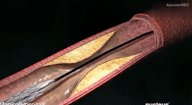 Cardiovascular Interventional Surgery