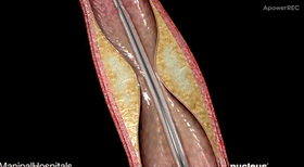 Cardiovascular Interventional Surgery