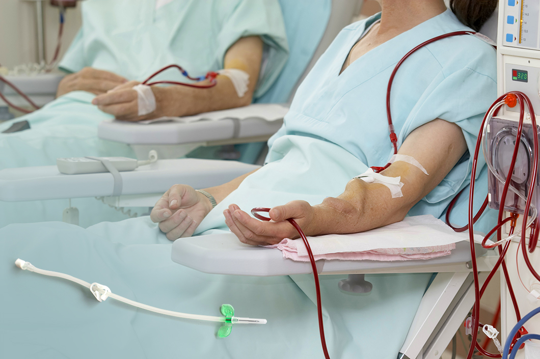 av fistula needle