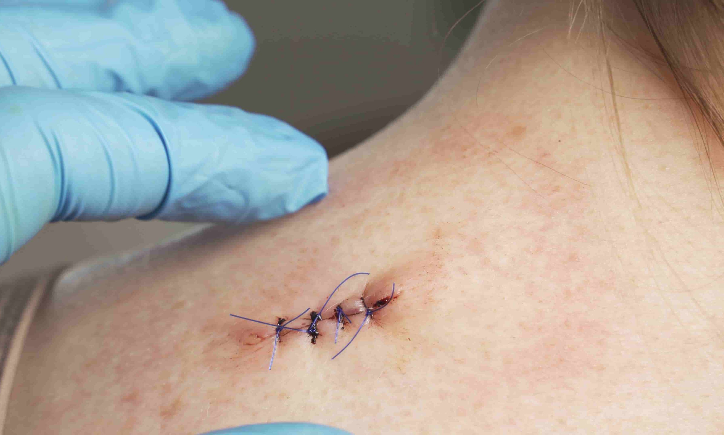suture reaction3.jpg