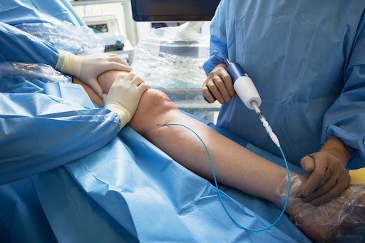 Varicose Vein Stripping