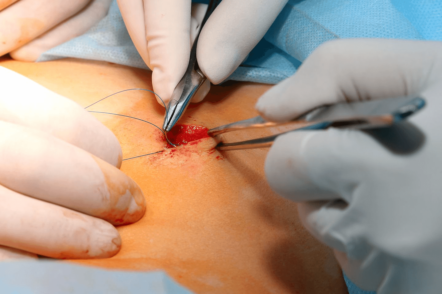 suture sizes3.png