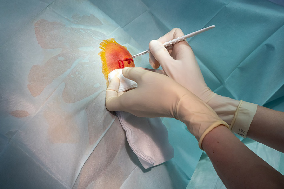 surgical site infection3.jpg