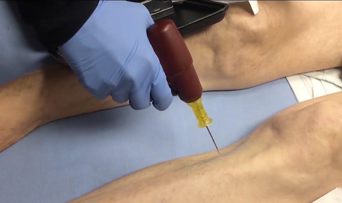 Intraosseous Access Complications2