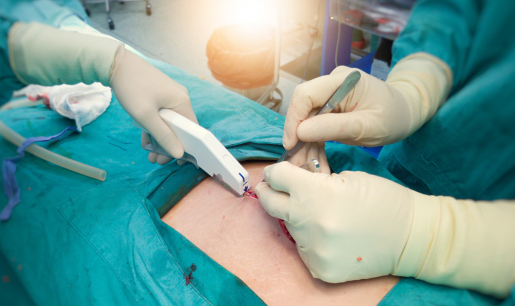 Medical Surgical Instrument Disposable Skin Stapler for Wound Suture