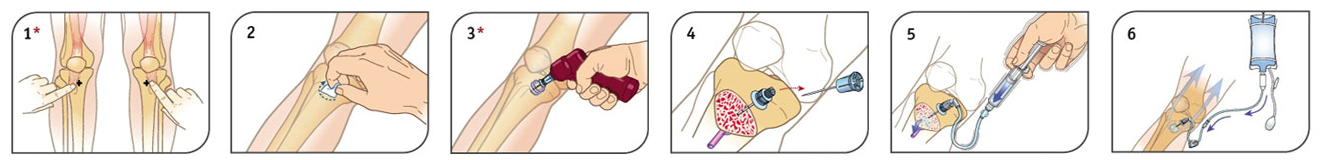 Intraosseous (IO) Infusion Device