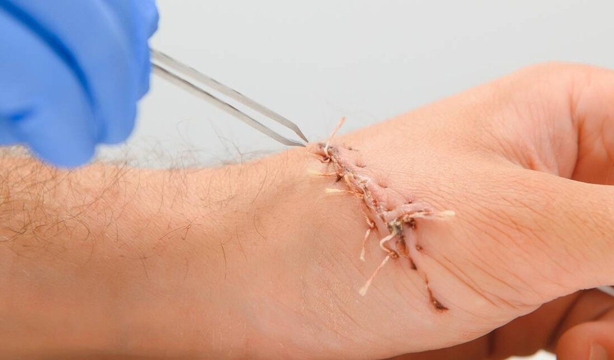 suture reaction2.jpg