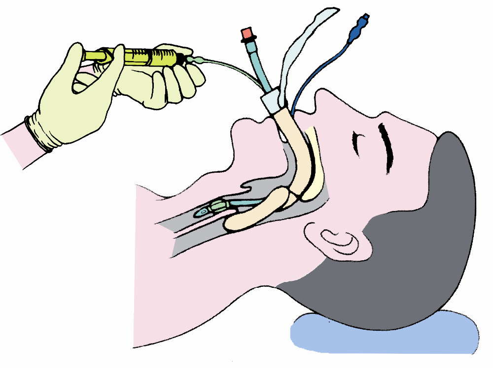 Disposable Sterile Tracheotomy Kit for Clinical Tracheostomy Operation