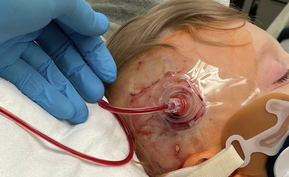 intraosseous access in pediatric2.png