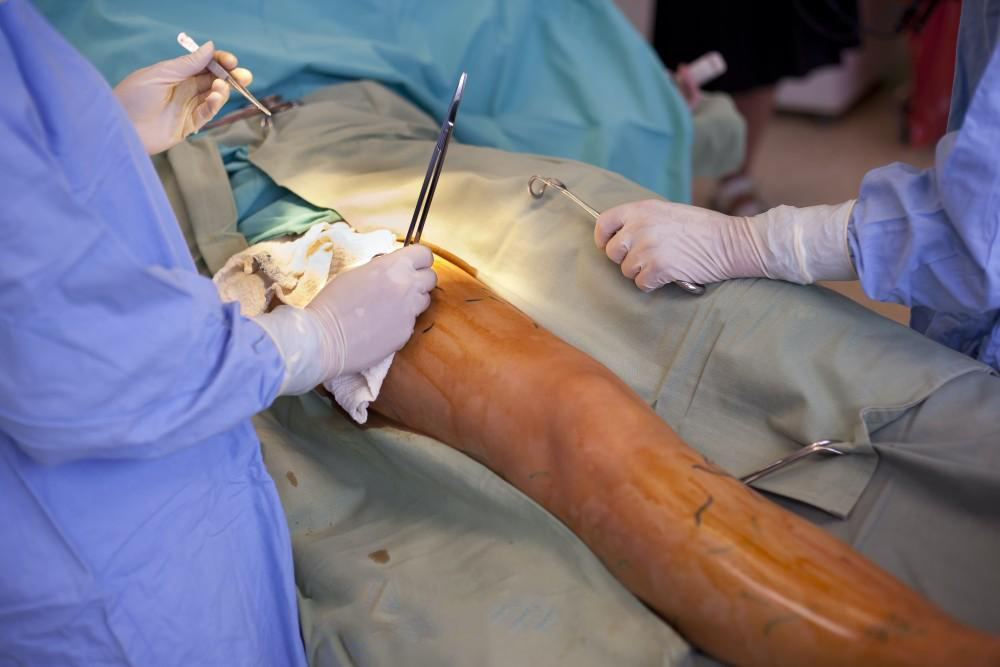 Varicose Vein Stripping