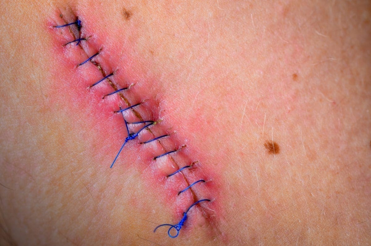 surgical site infection2.jpg