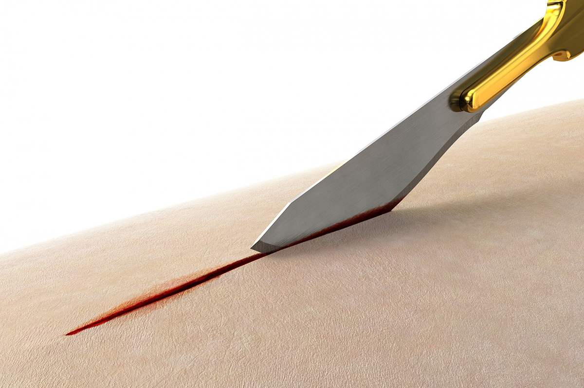 surgical scalpel3.jpg