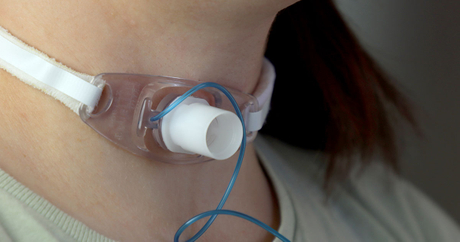 Blog-Tracheostomy-L.jpg