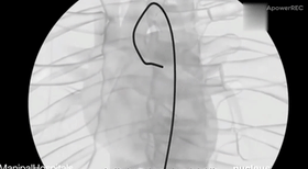 Cardiovascular Interventional Surgery