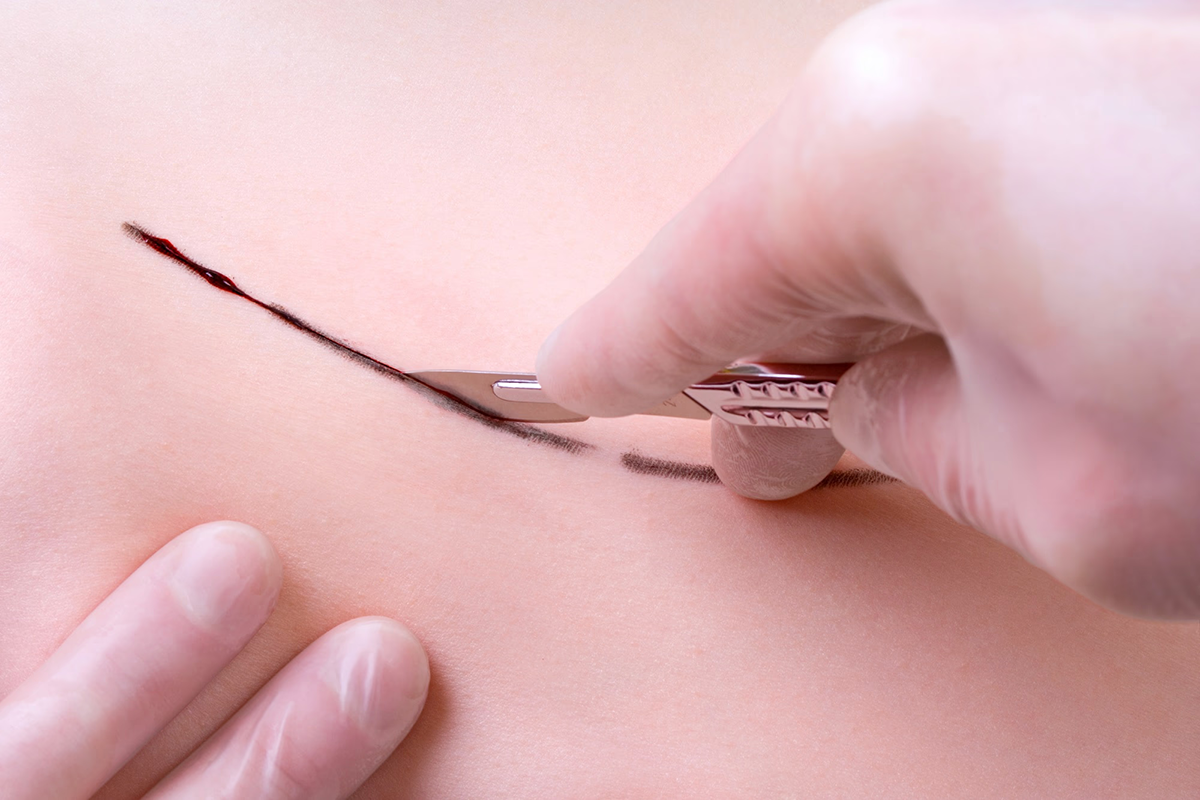 surgical scalpel2.png